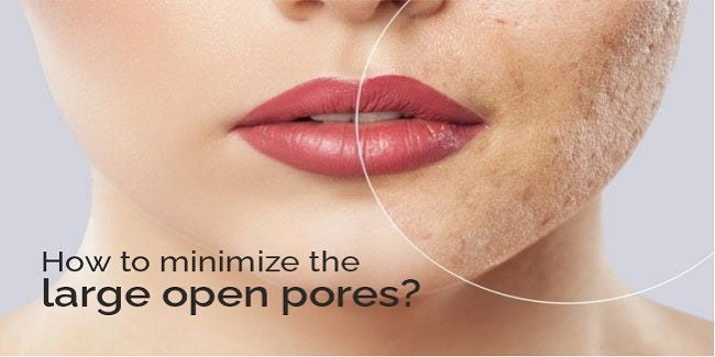 What is large open pores and how to minimize it?